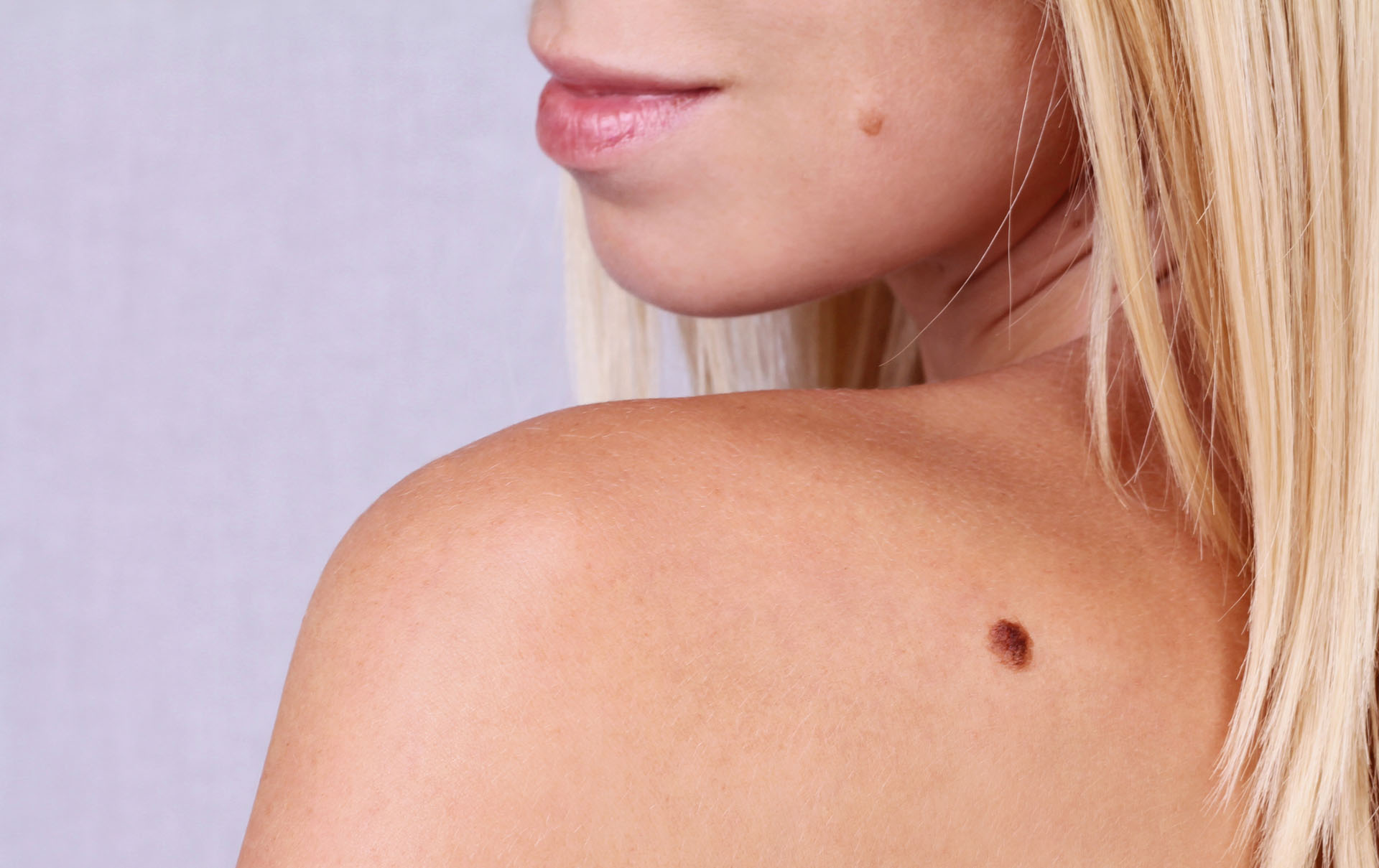 Young woman with birthmark on her face, back, skin. Checking benign moles. Skin tags removal