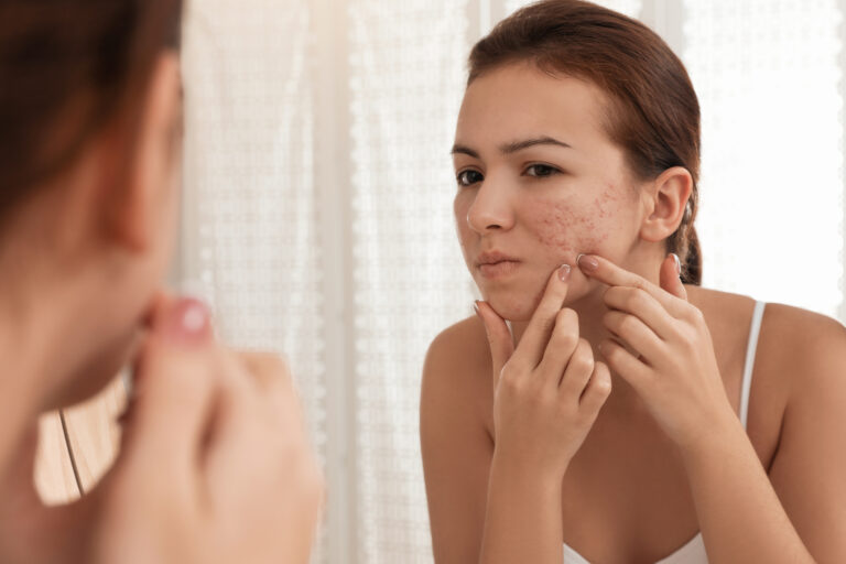 Teen,Girl,With,Acne,Problem,Squeezing,Pimple,Near,Mirror,In